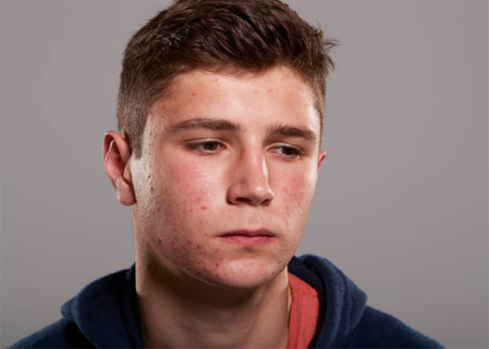 4 teen acne patents: Treatments that help reduce breakouts