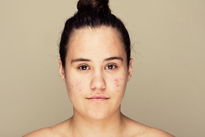 Acne sufferers have a 63% higher risk of developing major depression