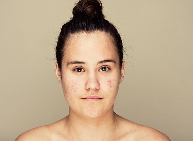 Acne sufferers have a 63% higher risk of developing major depression