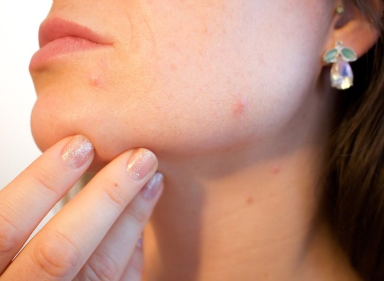 Acne sufferers more likely to experience depression and anxiety due to social stigma 