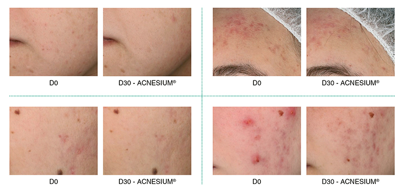 Acnesium: The daily care for acneic skin