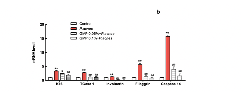 Antibacterial, anti-keratinised and anti-inflammatory effects of the GMP, a multi-herb extraction on acne vulgaris