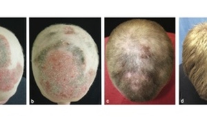 Arthritis drug shown to affect alopecia