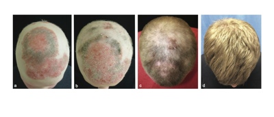 Arthritis drug shown to affect alopecia