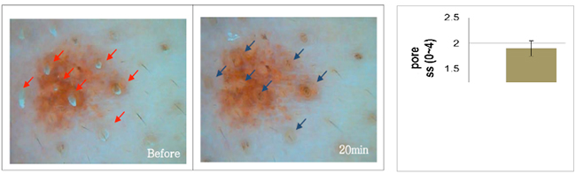 Figure 2. Clinical study of BioDTox on pore cleanliness.