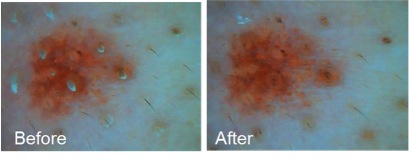 Figure 1. Change of pore cleanliness by using a foam cleanser containing 2% BioDTox