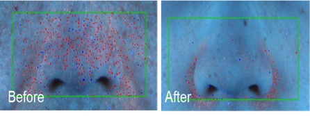 Figure 2. Change of sebum (indicated as red spots) by using a foam cleanser containing 2% BioDTox.