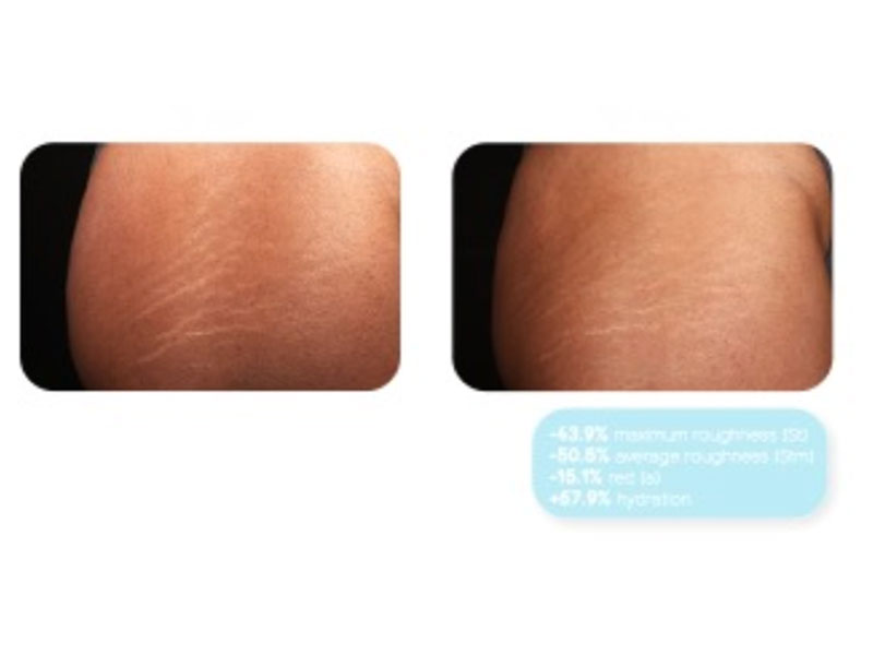 Discover how to repair stretch marks with Deepstrine