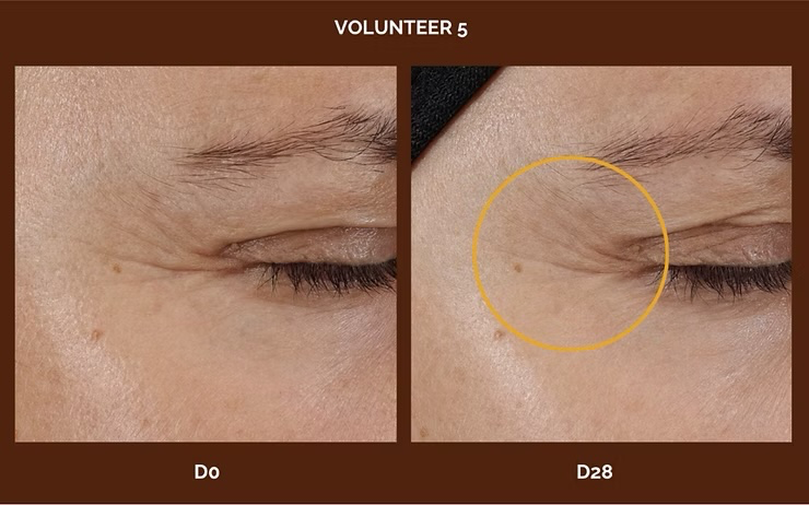 Macroscopic Pictures of crow’s feet wrinkles showing depth changes from Day 0 to Day 28 after treatment.