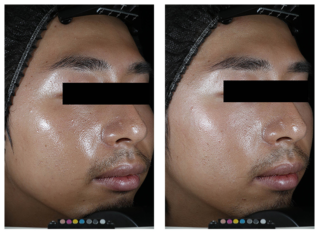 Images of the reduction in skin shine in Asian man, after 28 days
