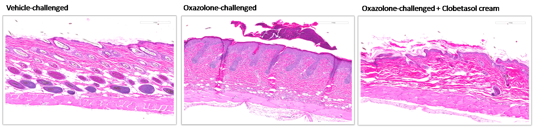 Figure 2: Histopathological changes in the skin of oxazolone-challenged NC/Nga and SKH-1 mice.<br> Note hyperkeratosis, acanthosis and infiltration of inflammatory cells and effects of clobetasol cream on these skin pathological changes.