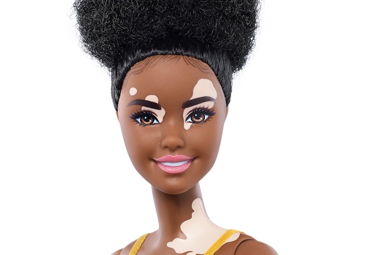 Barbie launches inclusive dolls with vitiligo and no hair to promote diversity in beauty
