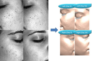 Bionos Biotech introduces new anti-acne efficacy testing at Suppliers' Day
