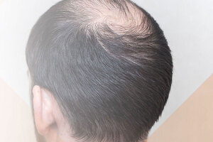Clinical studies of androgenetic alopecia treatment products