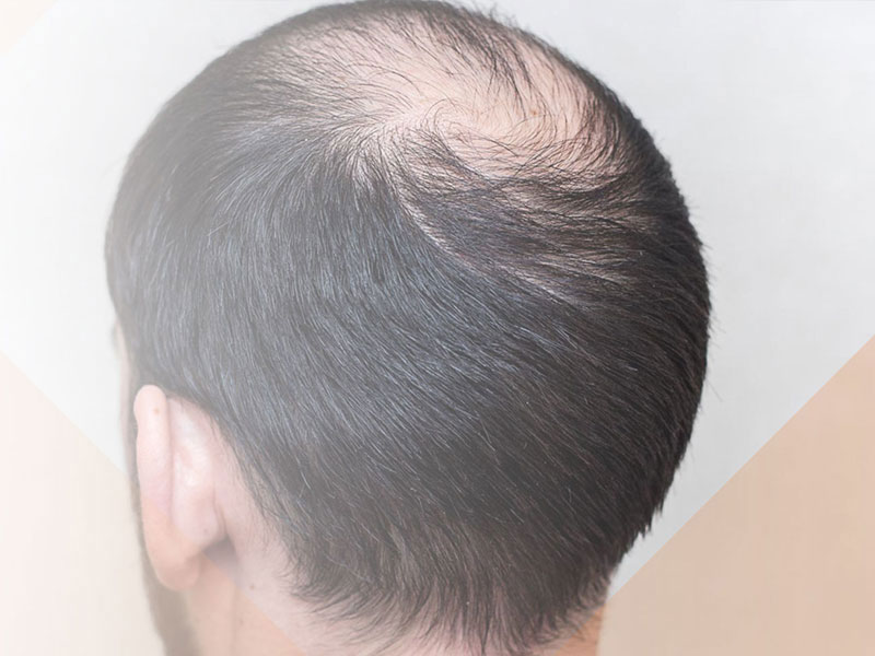 Clinical studies of androgenetic alopecia treatment products