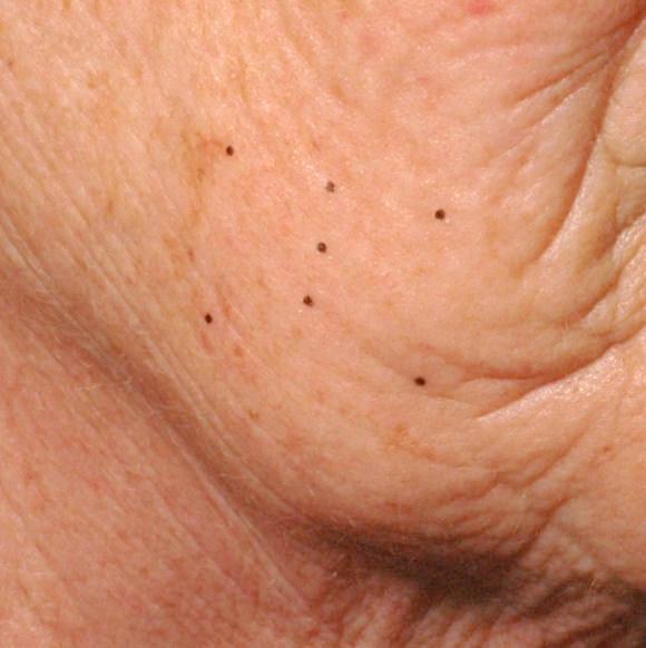 Combat sagging by stimulating elastin synthesis