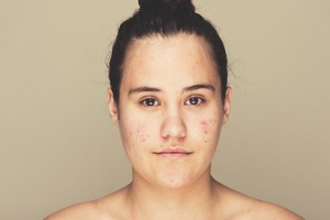 Complaint lodged over claims made by Harley Street acne clinic
