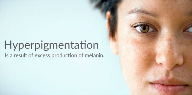 Cysteamine Cream for clearing your hyperpigmentary complexion 

