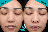 Dermscan clinical trial in Asia