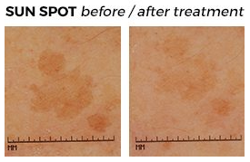 Dermscan discusses photoageing and how to assess it