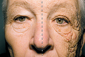 Dermscan discusses photoageing and how to assess it
