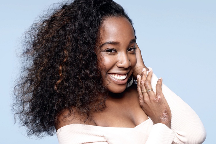 Dove hires models with skin conditions to promote new DermaSeries collection  