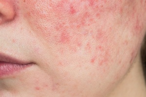 Everything you should know about rosacea and how skin care can help