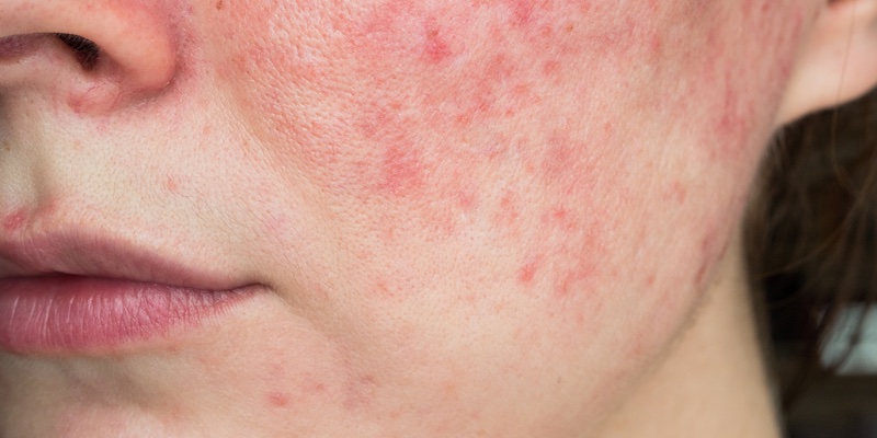 Everything you should know about rosacea and how skin care can help