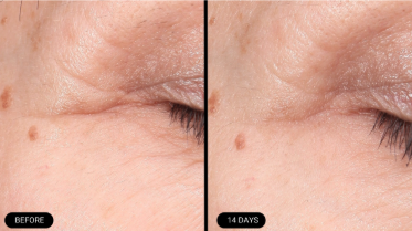 Before and after results using 1% Oleosome-EGF (peauvita™) in a placebo-controlled clinical study