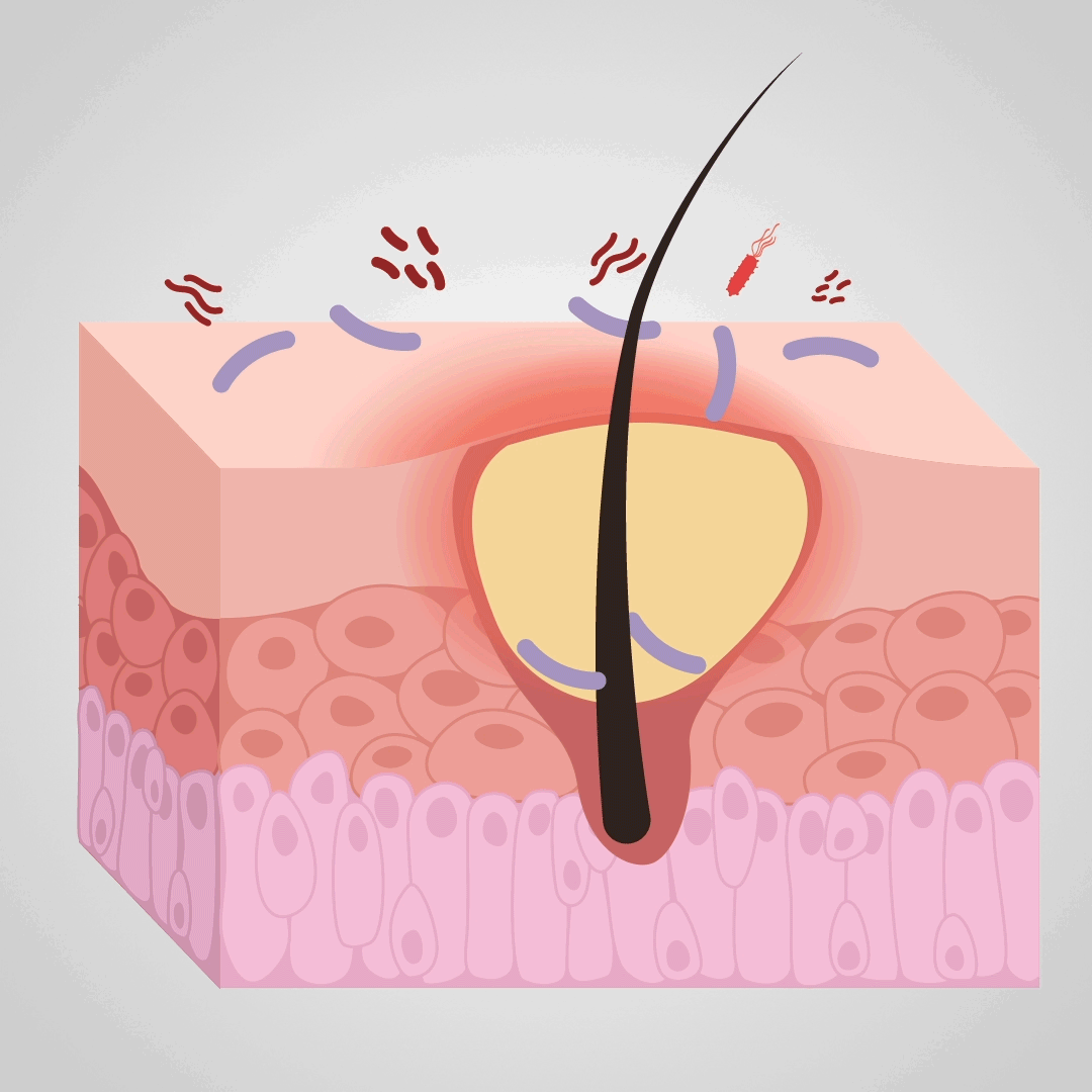 Reduce sebum production.