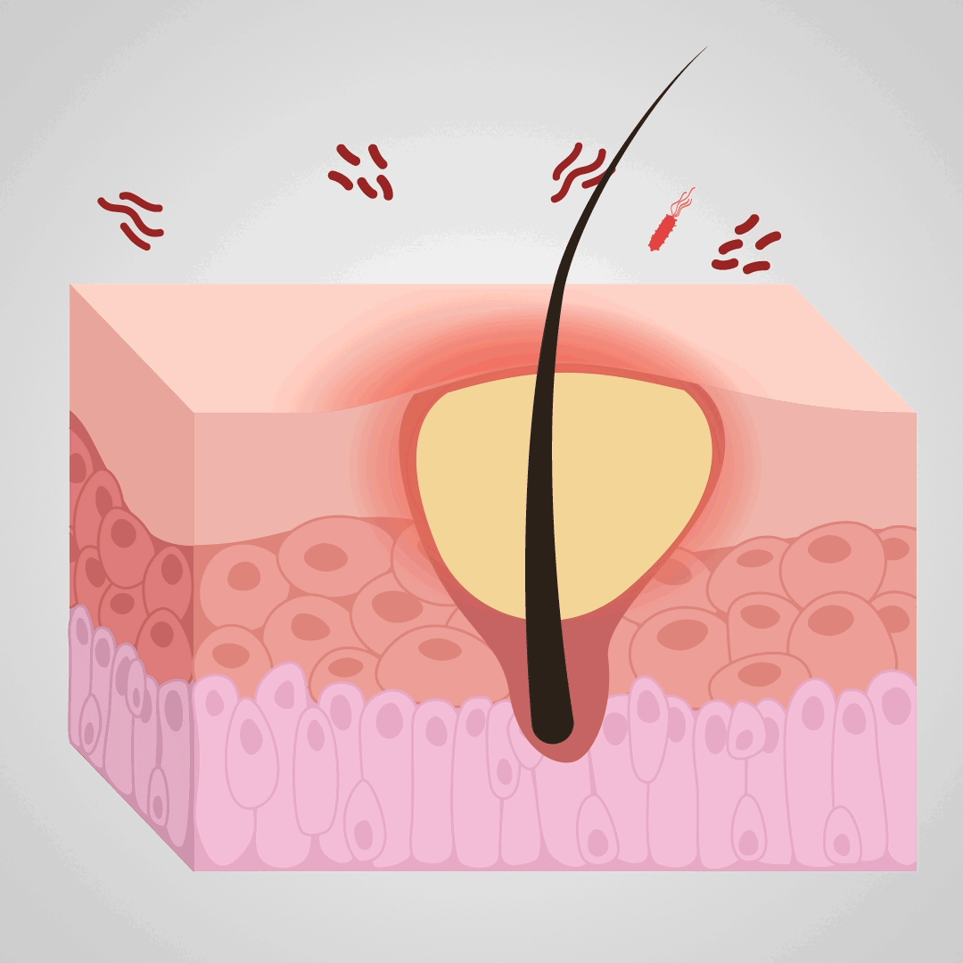 Balance the dysbiosis in hair follicles environment.