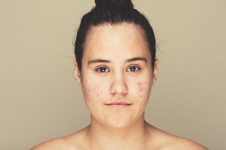 Frezyderm creates website to support acne sufferers