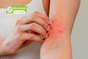 Global first microbiome-friendly standard for eczema-prone skin