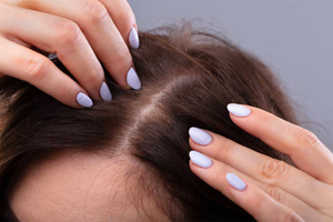 Hairburst helps over-35s with hair loss