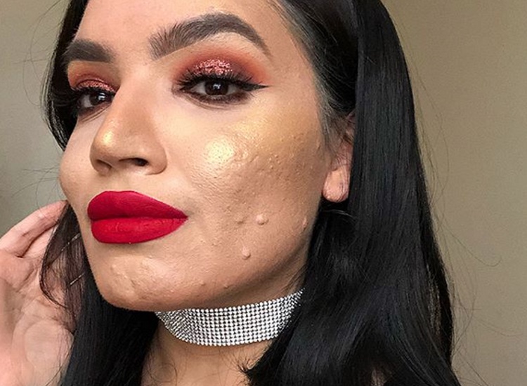 Influencer with acne ‘really hurt’ after being dropped by L’Oréal for upcoming project
