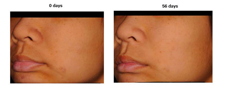 Lipochroman molecule has shown to help reduce pigment, homogenizing skin tone