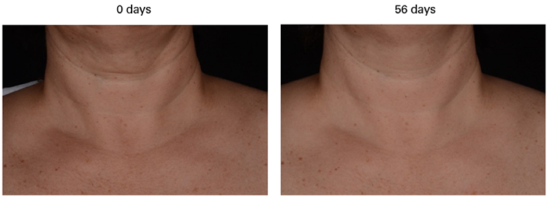 Lipotec brings the elixir of life mushroom for a glamorous décolleté