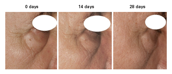 Lipotec confirms efficacy of EYESERYL peptide against baggy eyes in men