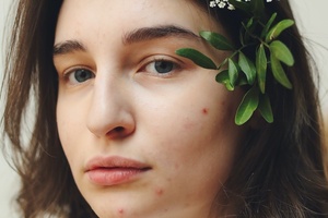 Low levels of omega 3 linked to acne 