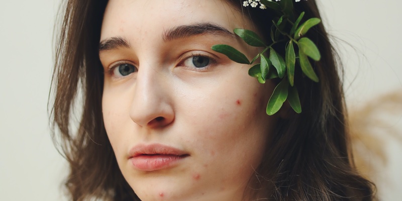 Low levels of omega 3 linked to acne 