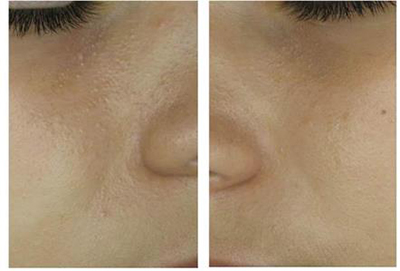 MATMARINE blue ingredient for an immediate mattifying effect