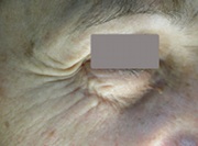 Matrixyl 3000 rewinds skin’s appearance 