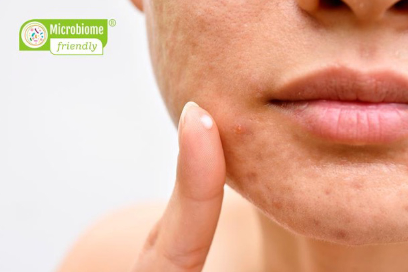Much longed for: MyMicrobiome launches Derm Standard for Skin Microbiome in Acne