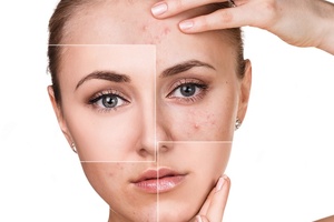 New digital service targets adult acne ‘epidemic’ with online prescription service 
