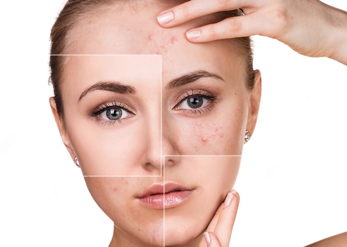 New digital service targets adult acne ‘epidemic’ with online prescription service 
