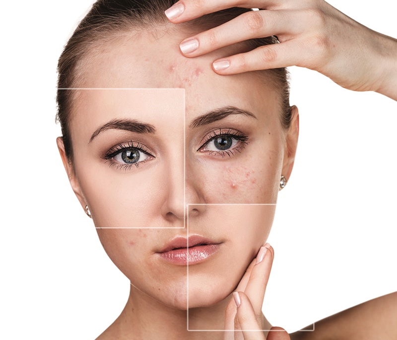 New LED light therapy devices increase convenience of anti-ageing and acne treatments