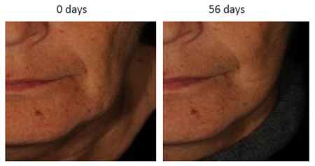 New test on Uplevity peptide: Reshaping the face contour