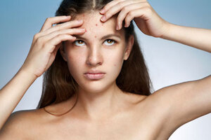 New US trial tests effect of bacteria on acne for first time