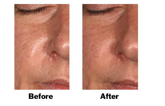 Olive extract to counter oily skin from Sederma