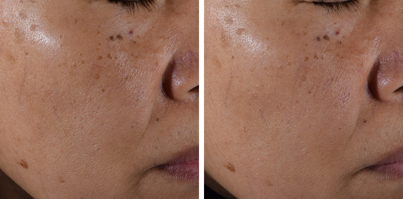 PoreTect’s efficacy demonstrated on Asian skin 

